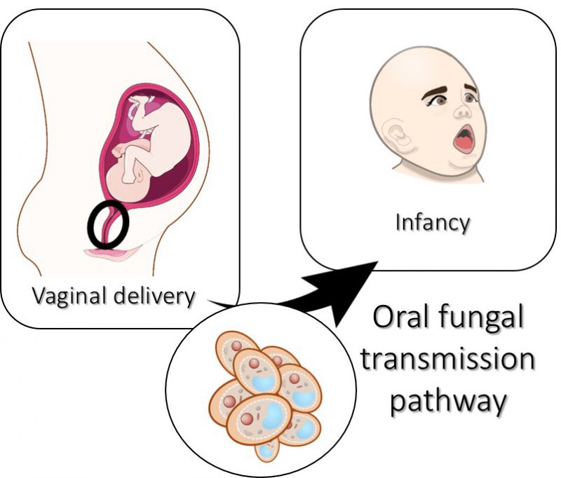Influence of delivery and feeding mode in oral fungi colonization – a ...